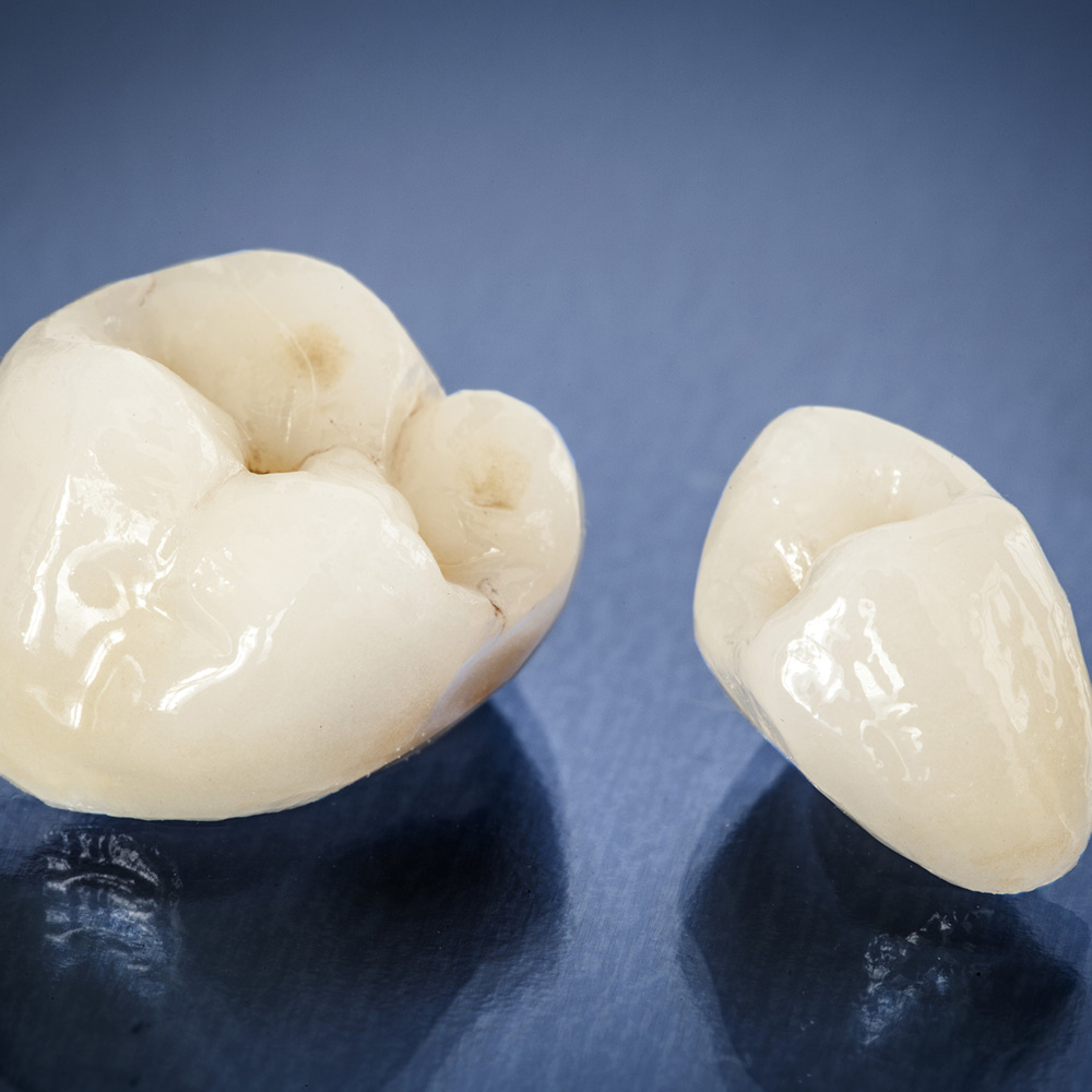 Dental Crowns