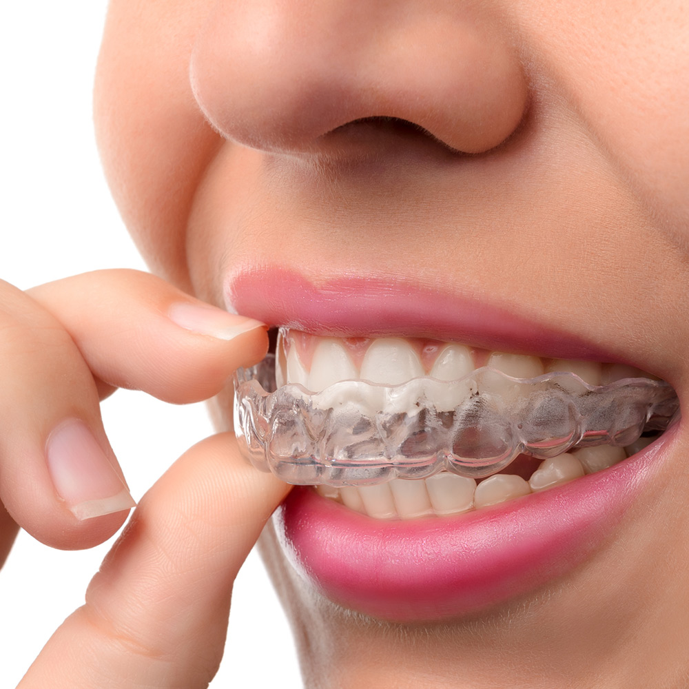 invisible aligners or braces