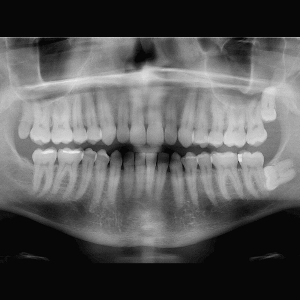 Wisdom Tooth Extractions