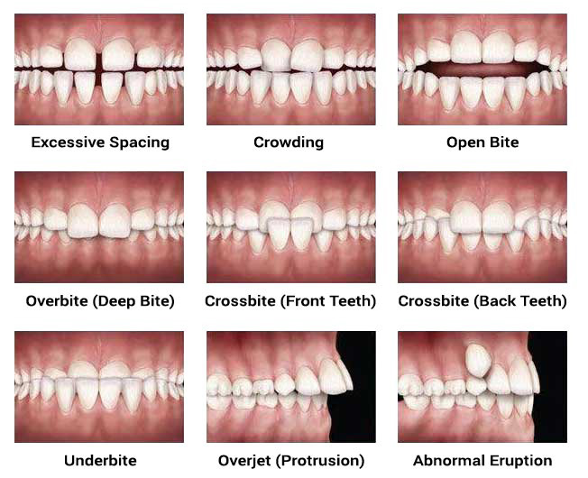 What Is A Closed Bite at Herlinda Oubre blog