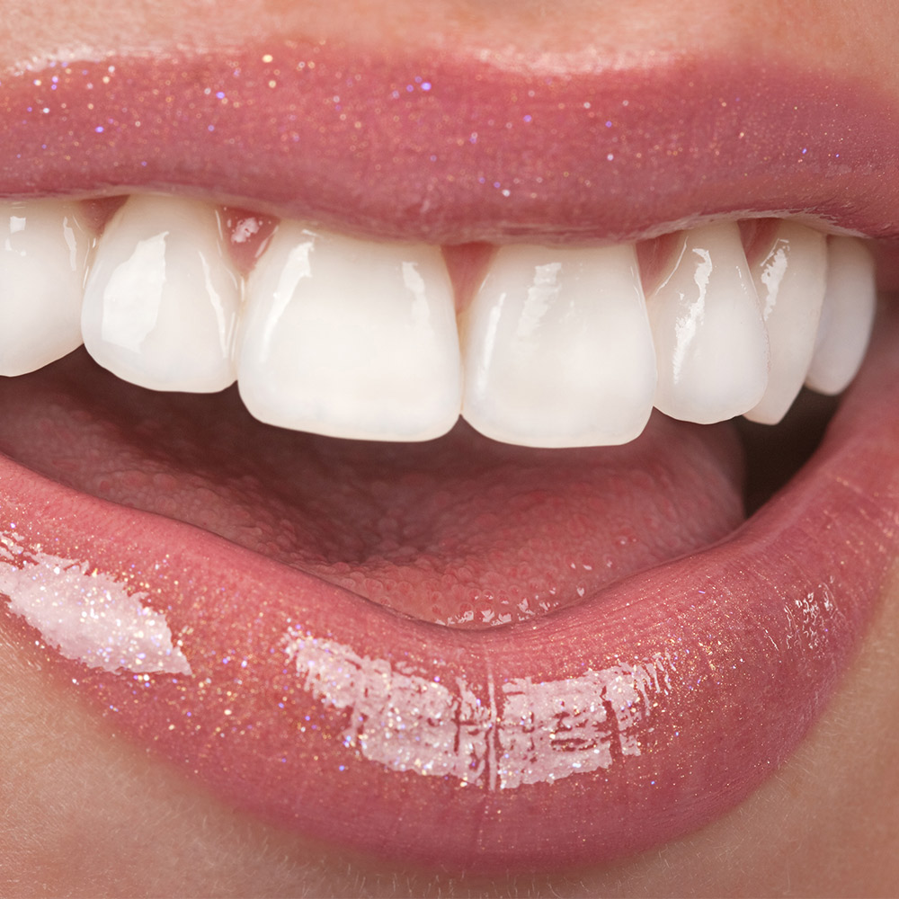 Porcelain Veneers