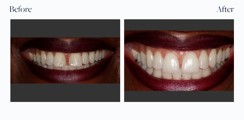 Before And After Downtown Dental Centre Toronto