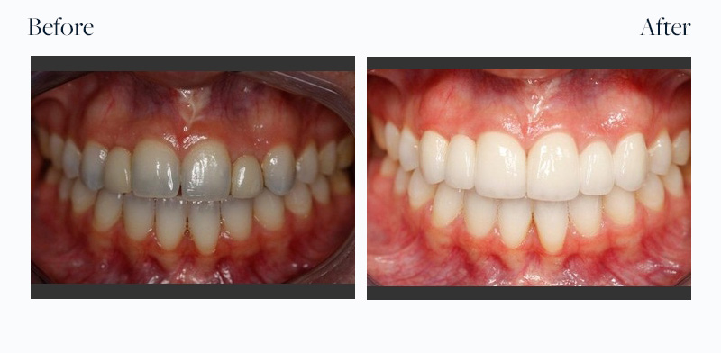 Before And After Downtown Dental Centre Toronto